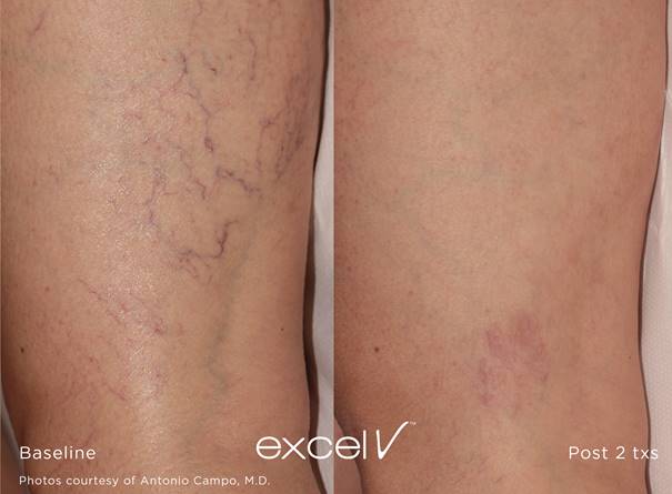 Excel V laserbehandeling van de benen